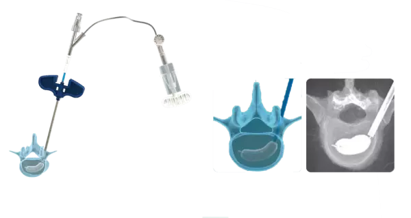 PCKP* Ballon-Kyphoplastie | die Revolution der Kyphoplastiesysteme